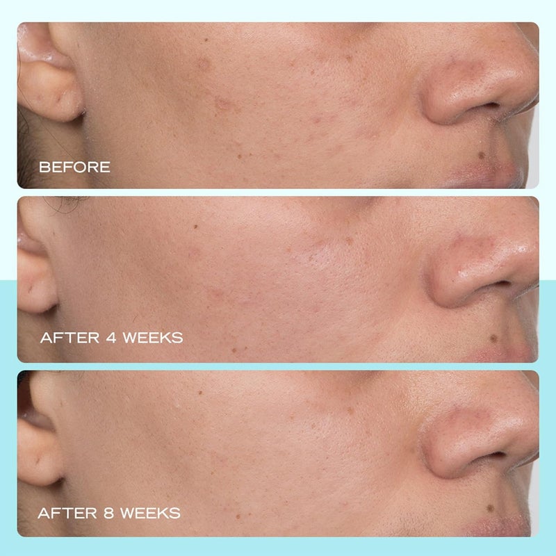 First Aid Beauty سيروم بقع داكنة من فيرست إيد بيوتي مع النياسيناميد يساعد في تقليل مظهر البقع الداكنة وبقع الشمس وفرط التصبغ وتغير اللون وآثار حب الشباب غير كوميدوغينيك وآمن للبشرة الحساسة 1 أونصة - Image 4