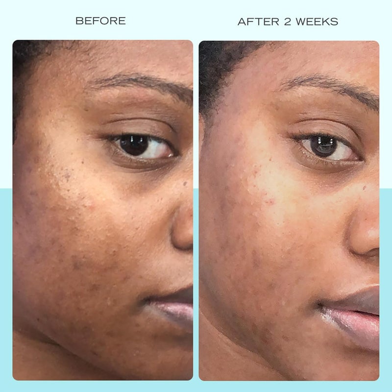 First Aid Beauty سيروم بقع داكنة من فيرست إيد بيوتي مع النياسيناميد يساعد في تقليل مظهر البقع الداكنة وبقع الشمس وفرط التصبغ وتغير اللون وآثار حب الشباب غير كوميدوغينيك وآمن للبشرة الحساسة 1 أونصة - Image 3