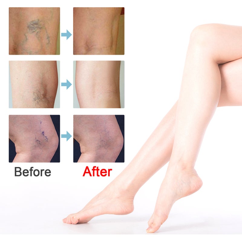 Varicose Veins Patch 10Pcs Plant-Based Formula - Skin Nourishing Soothing Leg Patch for Leg Varicosity Relief, Vasculitis Swelling Pain Reduction - Image 2