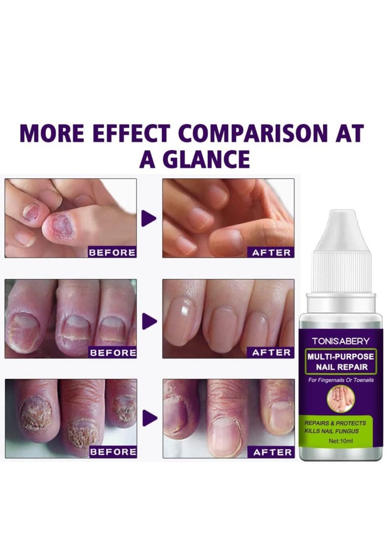 TONISABERY - Fungal Nail Repair Solution Natural Safe & Effective Repairs Protects Cuticles Removes Nail Infections Nourishing Fluid for Fingernails Toenails Remove Onychomycosis Unisex 10ml - Image 1