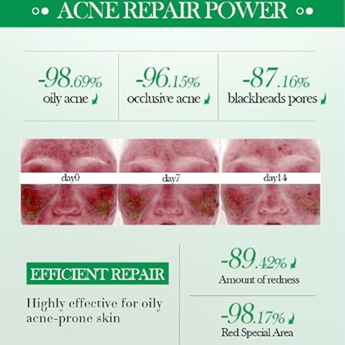 Grospe Salicylic Acid Repair Cream,Salicylic Acid Face Moisturizer,Pore Shrinkage Acne Skin Improves Acine Scars Motsturizing,Suitable for Oily, Acne Prone Skin 50g - Image 4