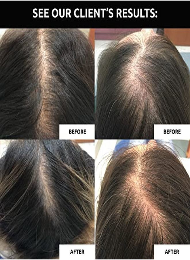 DS LABORATORIES - Growth Treatment For Women By Ds Laboratories Hair Growth Serum For Hair Loss And Thinning Hair In Women, Hair Loss Spot Treatment For Thicker, Fuller Hair (60Ml) - Image 1