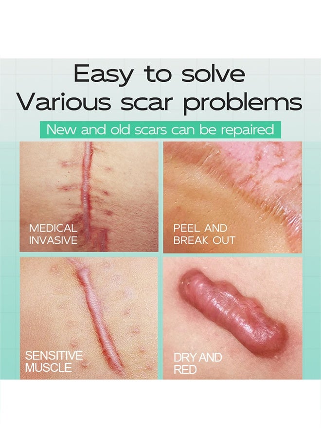 مايتشير كريم إزالة الندبات ، للبشرة ، كريم لتخفيف الندبات ، لعلاج الندبات الجراحية على الوجه يعالج مزيل الندبات القديمة والجديدة يقلل من ظهور الندبات من 15 جرام - Image 3
