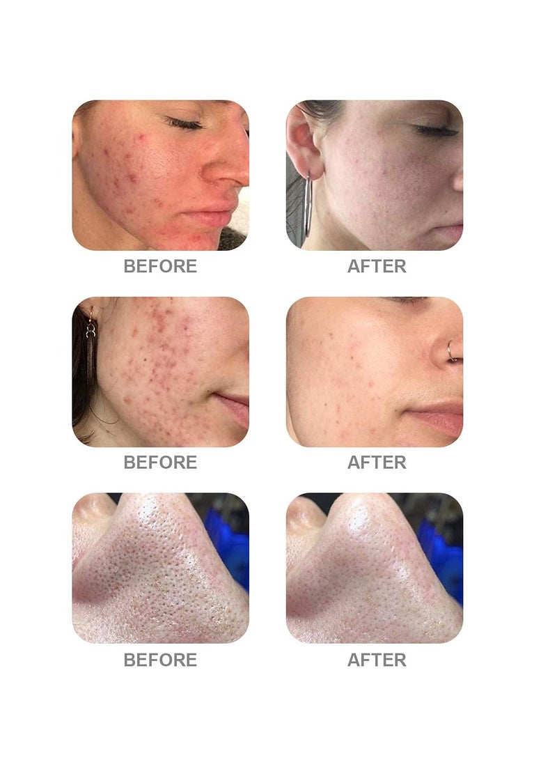 Hydrogen Oxygen Facial Machine Serums for Facial Cleansing – A Pack of 400ml 3 Aqua Peeling Solution AS1, SA2, and AO3 –Skin Care Hydra Solution for Vacuum face Cleaning Jet for Home and Spa - Image 5