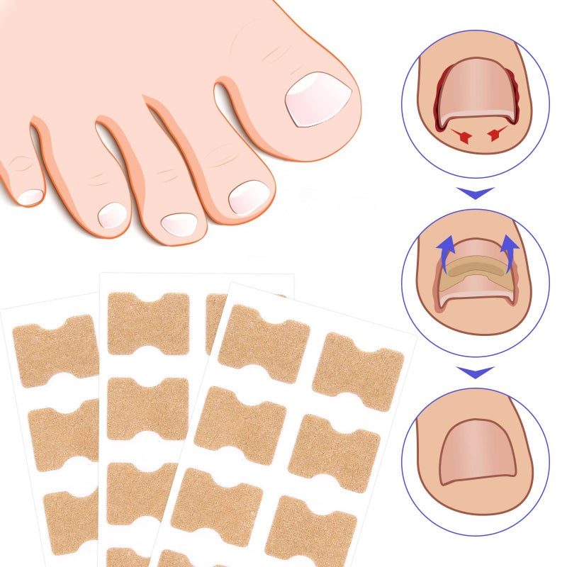 Sefudun Ingrown Toenail Corrector Patch, 100PCS Ingrown Toenail Corrector Strips, Toenail Correction Patches, Ingrown Toenail Treatment Tool Foot Care, No-Glue Toenail Correction Stickers - Image 3