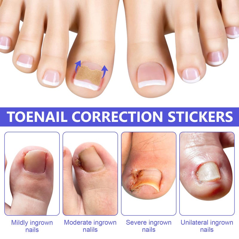 Sefudun Ingrown Toenail Corrector Patch, 100PCS Ingrown Toenail Corrector Strips, Toenail Correction Patches, Ingrown Toenail Treatment Tool Foot Care, No-Glue Toenail Correction Stickers - Image 5