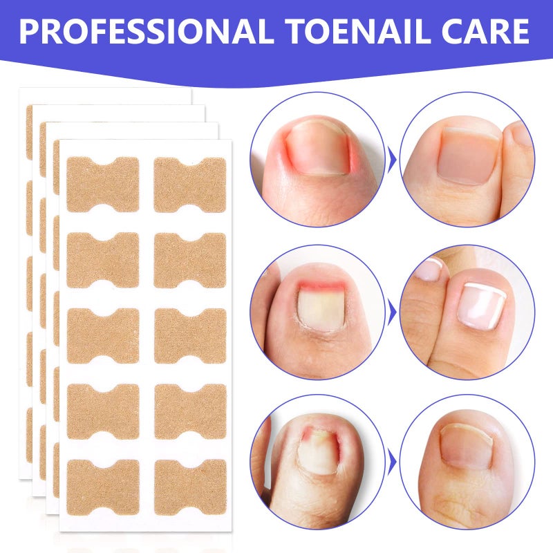 Sefudun Ingrown Toenail Corrector Patch, 100PCS Ingrown Toenail Corrector Strips, Toenail Correction Patches, Ingrown Toenail Treatment Tool Foot Care, No-Glue Toenail Correction Stickers - Image 4