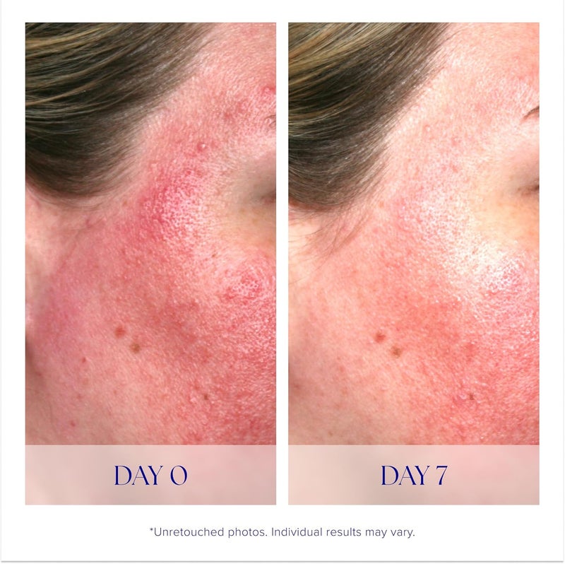 iS Clinical Pro-Heal Serum Advance+ - 0.5 fl. oz. (14.8 ml) - Antioxidant Face Serum for Redness-Prone and Aging Skin - Image 4