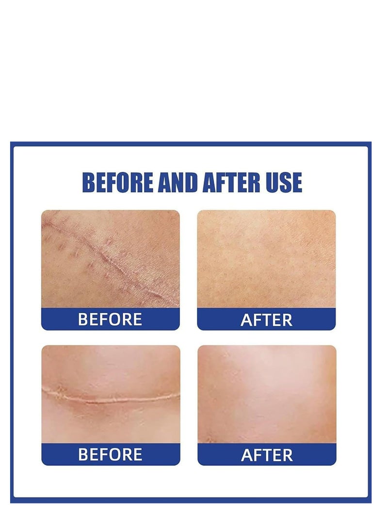 Silicone Scar Sheets, Reusable Washable Silicone Scar Tape, Surgery Scars Removal Treatment, Medical Grade Silicone Scar Sheets for Breast 4Pairs