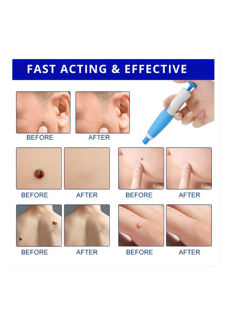 Sefudun Painless and easy to use wart removal tool double ended blue: Effectively removes skin markers, corn kernels, warts and meatballs from the face, neck and whole body for skin problems of all sizes - Image 4