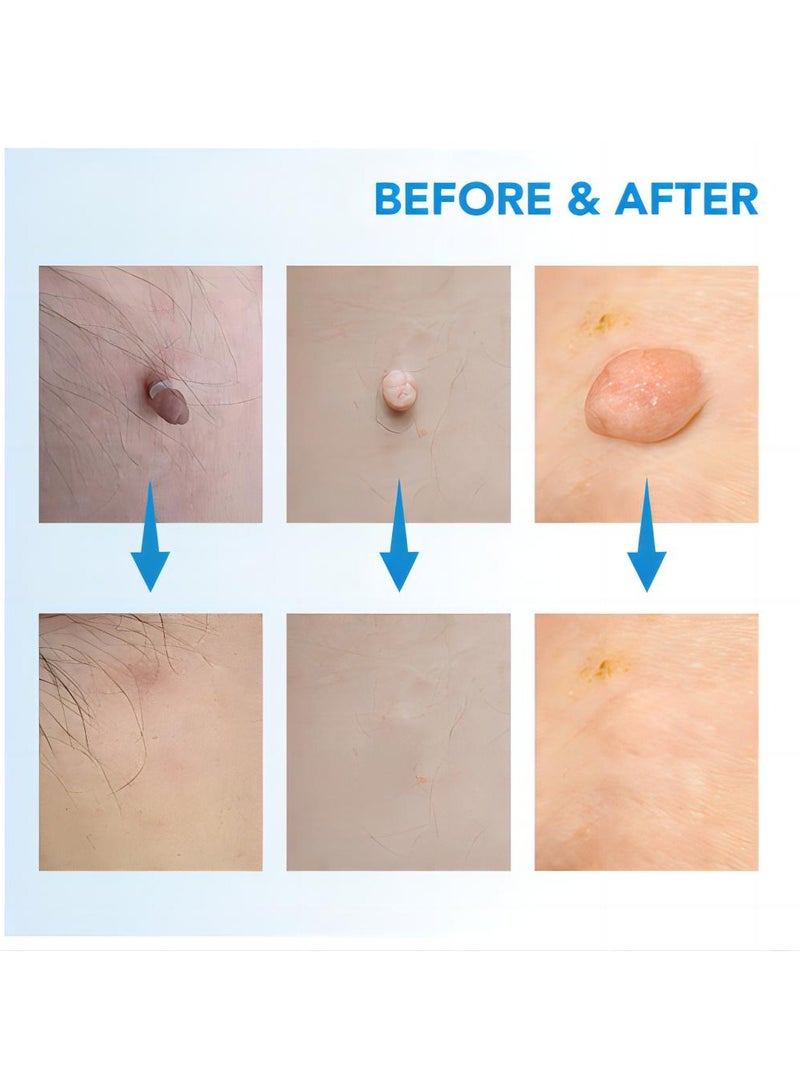 Sefudun Painless and easy to use wart removal tool double ended blue: Effectively removes skin markers, corn kernels, warts and meatballs from the face, neck and whole body for skin problems of all sizes - Image 5