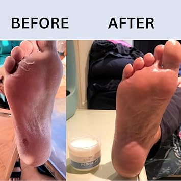 Marble Hill PediSalve Foot Cream Fast Relief Very Dry Feet Hard Skin Cracked Heels Diabetic Foot Care Eczema Shea butter Vit E Developed by Medical Doctor Marble Hill 100g - Image 4