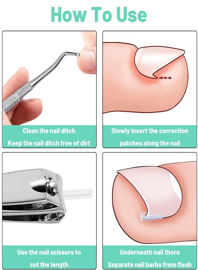 Aeenioy Ingrown Toe Nail Remover, Toe Nail Corrector Kit for Men and Seniors, Professional Ingrown Toenail Correction Tool, Home Foot Care Solution for Daily Nail Maintenance - Image 4