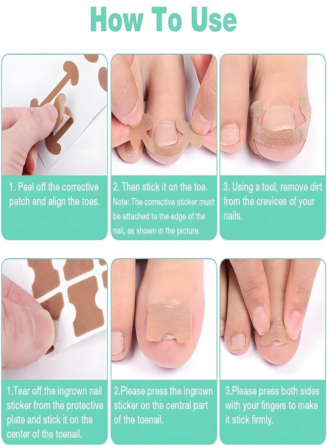 Aeenioy Ingrown Toe Nail Remover, Toe Nail Corrector Kit for Men and Seniors, Professional Ingrown Toenail Correction Tool, Home Foot Care Solution for Daily Nail Maintenance - Image 5