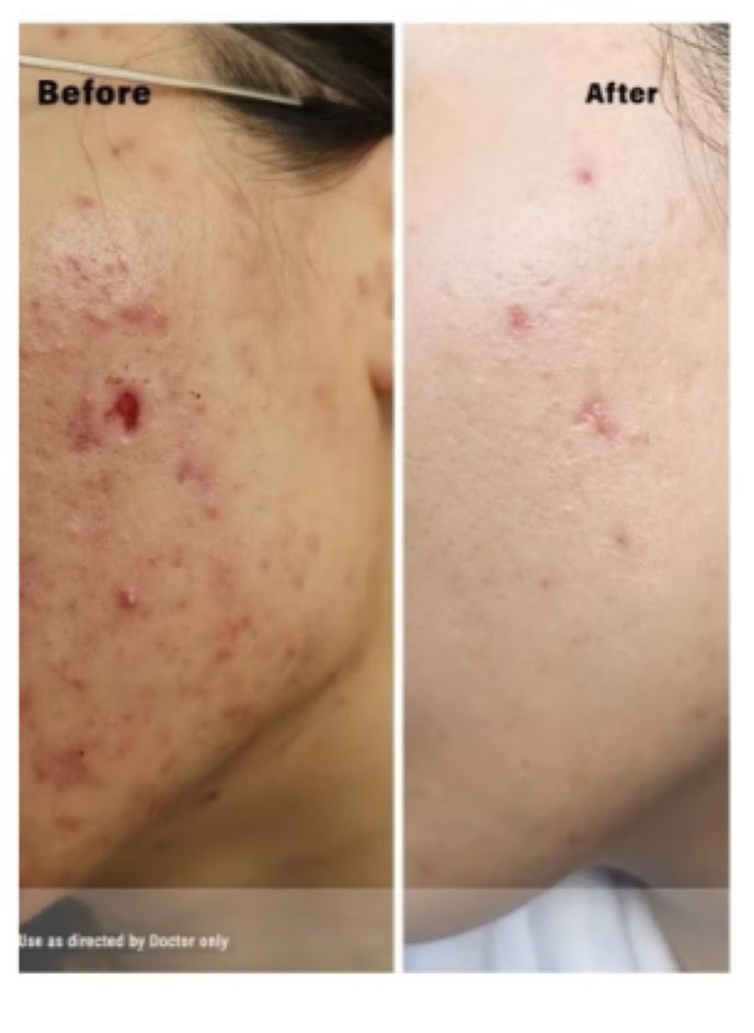 Jamjoom Medical solution Skin Care Set for the Optimal and Ultimate Treatment for Acne and Skin Problems(Acretin 0.05% Acne Cream 30 gm + Hi Quin Pro Whitening Exfoliating Acne Treatment 4% Cream 30 gm + Acretin 0.025% Cream 30 gm)  - Image 3