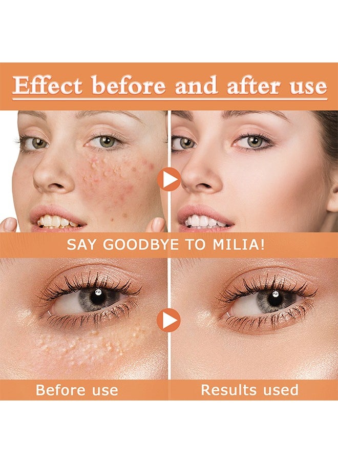 OUHOE - Fat Particles Treatment-Fat Granule Clearing Skin Essense，Fat Granules Removal Eye Serum, Natural Formula Milia Remover Milia Spot Treatment, Anti Dark Circle Fade Fine Essence, Anti Puffiness Moisturizing Skin Care Serum - Image 1