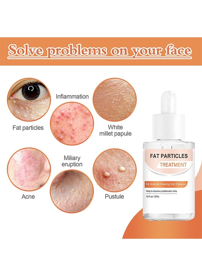 OUHOE - Fat Particles Treatment-Fat Granule Clearing Skin Essense，Fat Granules Removal Eye Serum, Natural Formula Milia Remover Milia Spot Treatment, Anti Dark Circle Fade Fine Essence, Anti Puffiness Moisturizing Skin Care Serum - Image 1