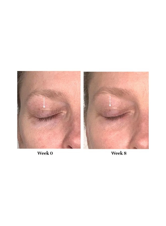City Beauty Lid Lifting Treatment| Hooded Eyelid Lift Treatment Cream | Eye Tightening Treatment for Sagging Eyelids - Image 3