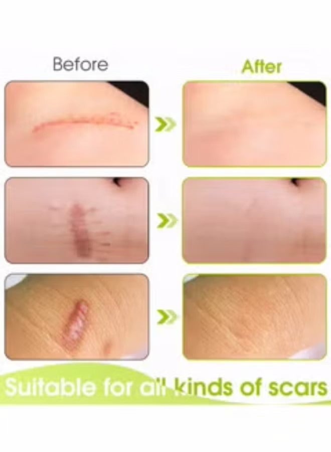 ساوث مون ندبة سيليكون التصحيح تتلاشى الندوب إزالة ندبة مستحضرات التجميل الفعالة للعملية القيصرية ندبات الحروق والندوب الأخرى التي خلفتها لفة شريط جل غير مؤلمة (4 سم × 1.5 م) - Image 3