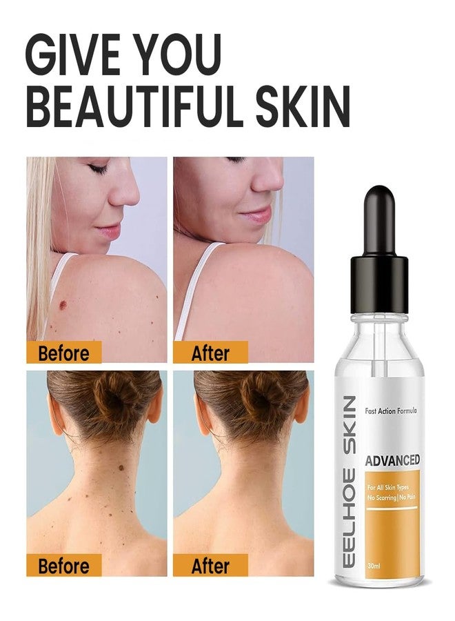 Mullica®Skin Tag & Mole Remover Serum - Quick-Acting Natural Formula for Face and Body - Simple to Use, 30ML - Image 5