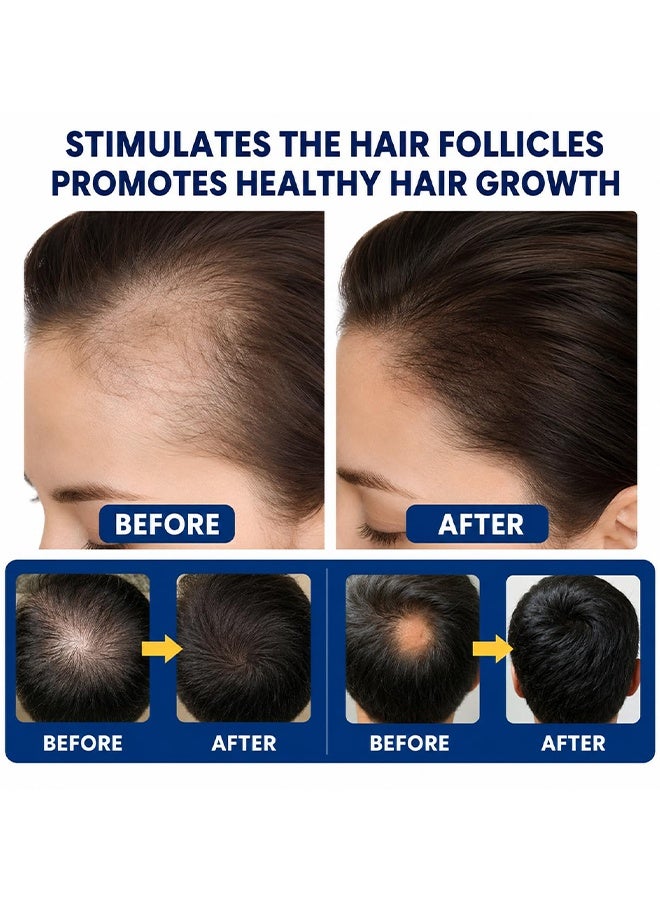 Sumifun Alopecia Hair Growth Spray For Promote Men's Hair Growth, Prevent Hair Loss, Care For Hair, Anti Hair Loss Spray For Thicker Fuller Hair, Scalp Nourishing Butter For Thinning Hair, Intensive Hair Densifying Essence, 30ml - Image 3
