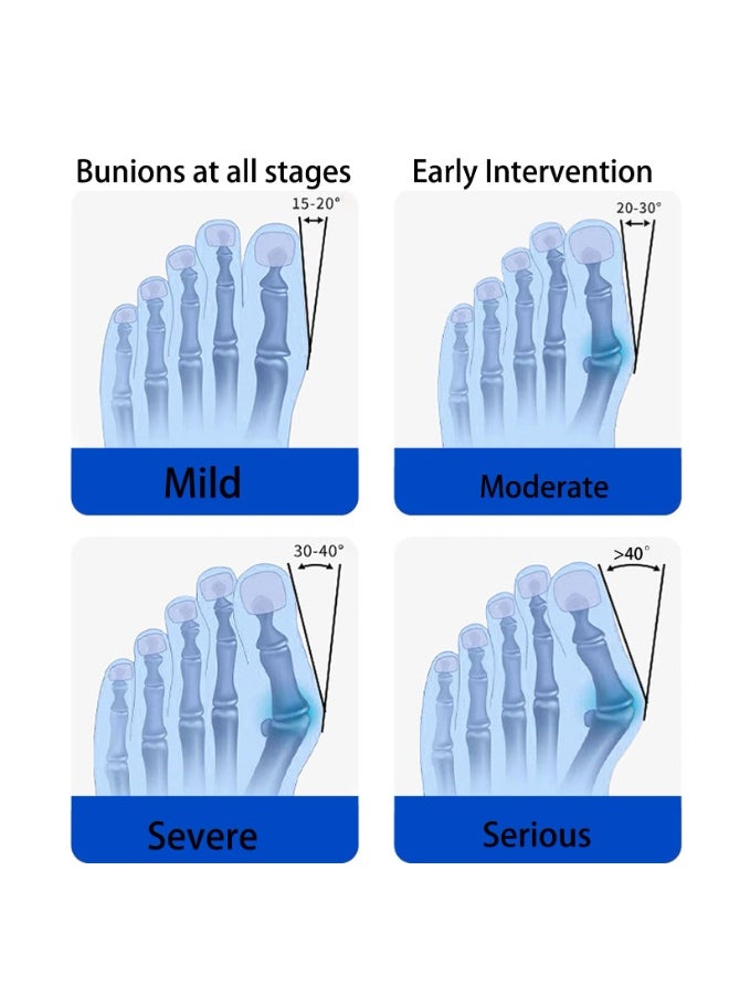 jalan Bunion Corrector, Adjustable Knob Bunion Splint For Bunion Relief, Suitable For Left And Right Foot Toe Correction  - Image 5
