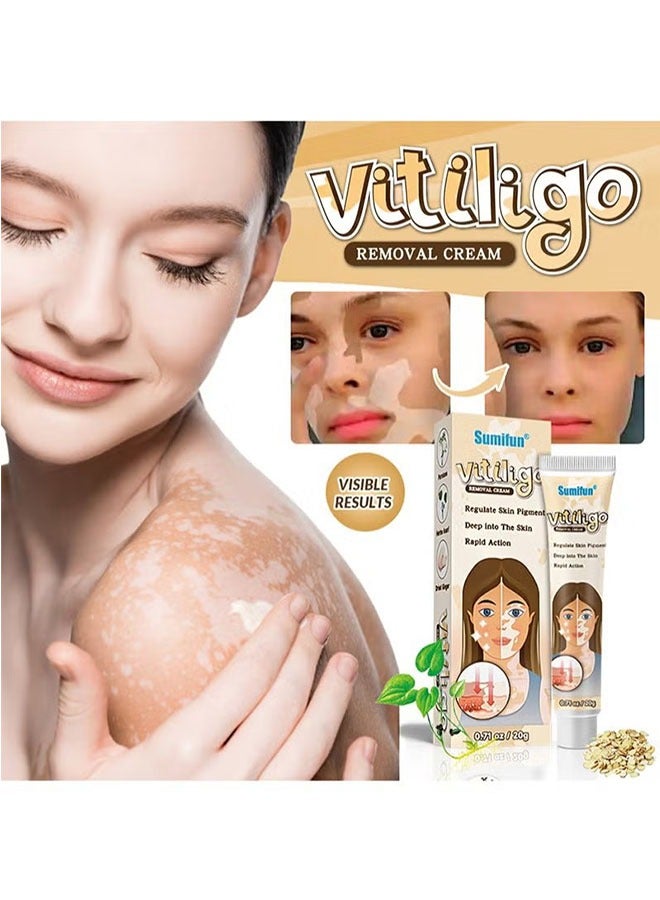 سوميفون كريم إزالة البهاق 20G ، علاج البهاق الجلدي ، والحد من البقع البيضاء ، وتحسين تصبغ الجلد كريم الرعاية البهاق - Image 5