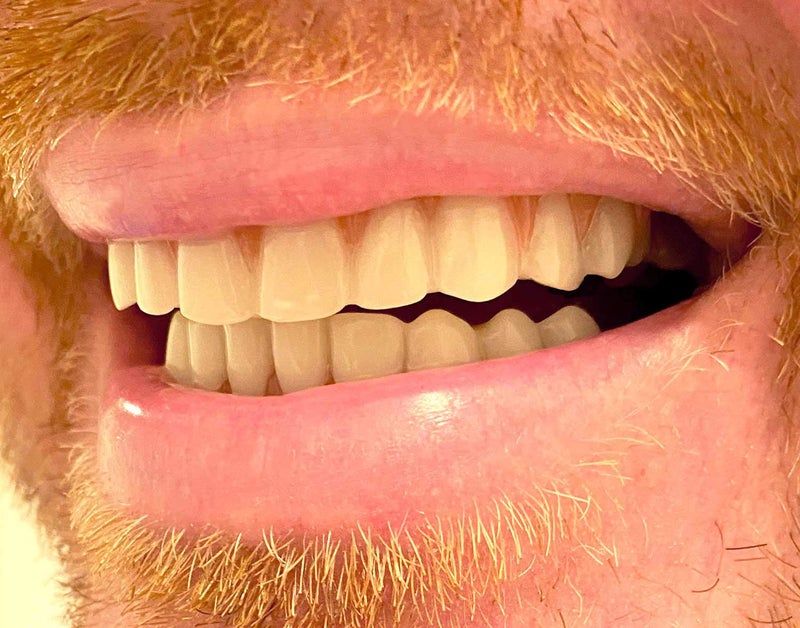 Instant Smile Comfort Fit Flex Teeth - Upper and Lower Matching Set, Natural Shade! Fix Your Smile at Home Within Minutes! - Image 3