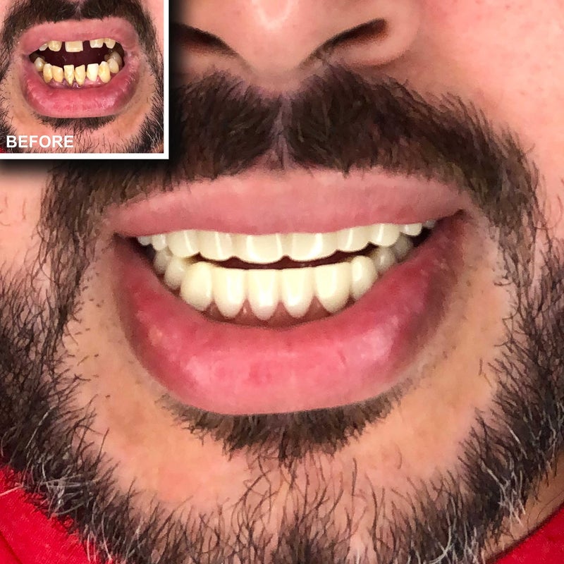 Instant Smile Comfort Fit Flex Teeth - Upper and Lower Matching Set, Natural Shade! Fix Your Smile at Home Within Minutes! - Image 5