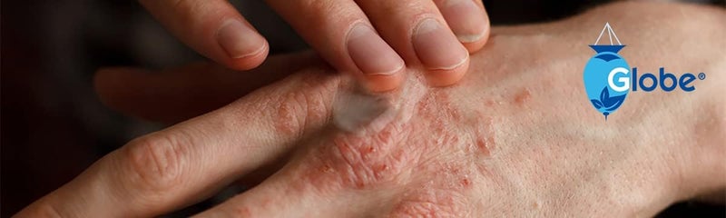 Globe مرهم هيدروكورتيزون 1% أقصى قوة شفاف 1 أونصة | مرهم مضاد للحكة للاحمرار، التورم، الحكة، الطفح الجلدي، التهاب الجلد، لدغات الحشرات/البعوض، الإكزيما، البواسير والمزيد (12 عبوة) - Image 4