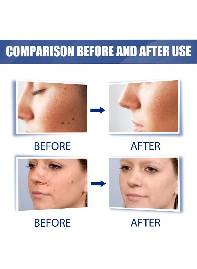 EELHOE Wart Removal - Natural Herbal Wart Remover Treatment Skin Repair Cream Against Moles Warts Use On Any Parts Of Body 20g  - Image 5