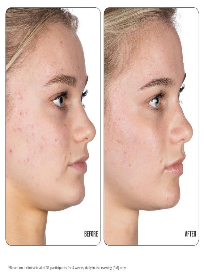 NIP+FAB علاج جل نيب + فاب ريتينول فيكس للبثور 10% مركب، 0.5 أونصة سائلة، 0.1% ريتينول نقي محاط، 2% نياسيناميد، 2% تريفالين، 0.5% حمض الساليسيليك لاستهداف البثور، البقع الداكنة وحجم المسام - Image 4