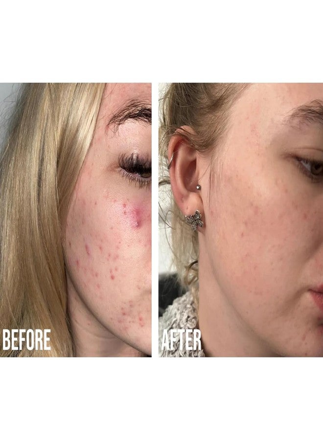 NIP+FAB علاج جل نيب + فاب ريتينول فيكس للبثور 10% مركب، 0.5 أونصة سائلة، 0.1% ريتينول نقي محاط، 2% نياسيناميد، 2% تريفالين، 0.5% حمض الساليسيليك لاستهداف البثور، البقع الداكنة وحجم المسام - Image 5