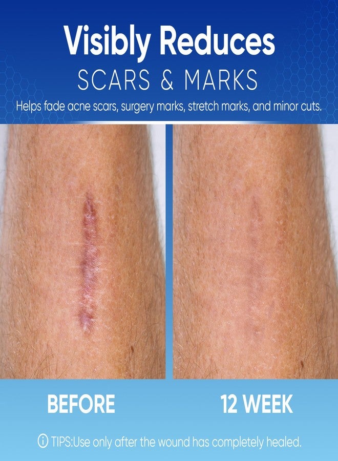 Aroamas Scar Silicone Scar Tape - Medical-Grade Silicone Scar Sheets to Help Improve The Appearance of Scars and Scratch Marks, Reusable for Face & Body [3" x 1.57", 8 Sheets] - Image 3