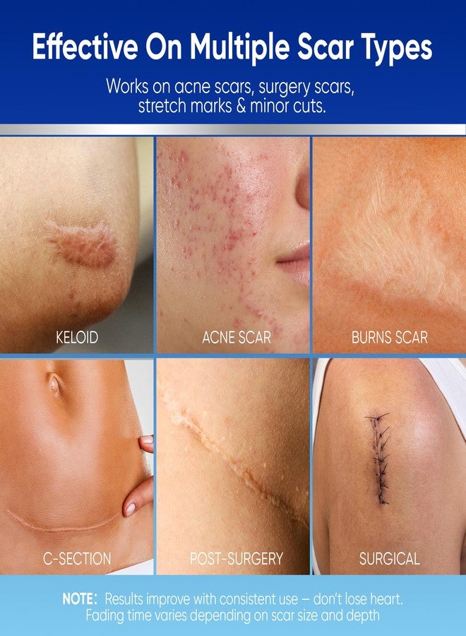 Aroamas Scar Silicone Scar Tape - Medical-Grade Silicone Scar Sheets to Help Improve The Appearance of Scars and Scratch Marks, Reusable for Face & Body [3" x 1.57", 8 Sheets] - Image 2