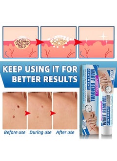 Jaysuing Skin Tag Wart Removal Ointment  - Wart Remover Ointment Maximum Strength - Plantar Warts - Natural Safe And Easy To Use - 20G  - Image 3