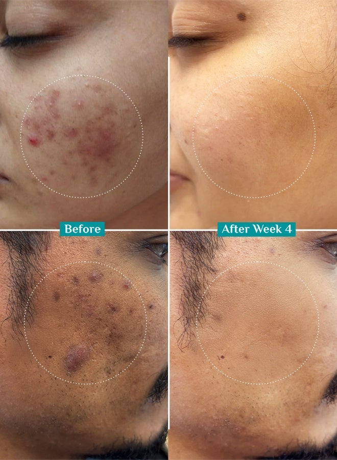 PILGRIM 10% Niacinamide Face Serum For Acne Marks 30Ml | Fades Blemishes & Dark Spots | Oil Control | Brightens & Evens Skin Tone | All Skin Types | Women & Men - Image 5