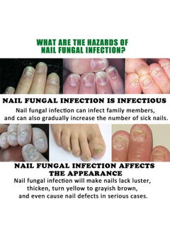 7days Nail Fungus Treatment for Nail Care Onychomycosis Repair and Moisturizing, Nail Nutrient Oil Strengthener Oil Serum Ginger Nail Growth Oil 30ml - pzsku/ZE89B56625C233CBF8EC5Z/45/_/1730191710/e1eeff7c-2865-4175-bf91-ddd3f011eaed