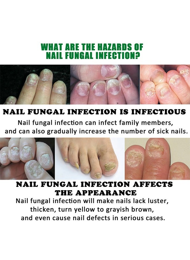 7days Nail Fungus Treatment for Nail Care Onychomycosis Repair and Moisturizing, Nail Nutrient Oil Strengthener Oil Serum Ginger Nail Growth Oil 30ml