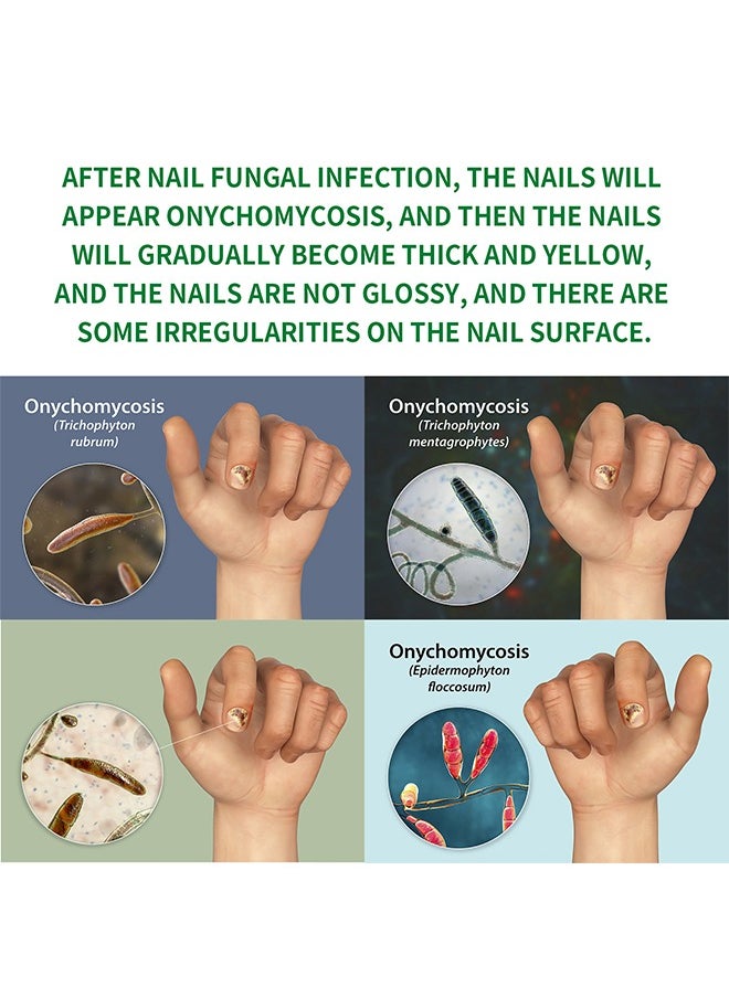 7days Nail Fungus Treatment for Nail Care Onychomycosis Repair and Moisturizing, Nail Nutrient Oil Strengthener Oil Serum Ginger Nail Growth Oil 30ml
