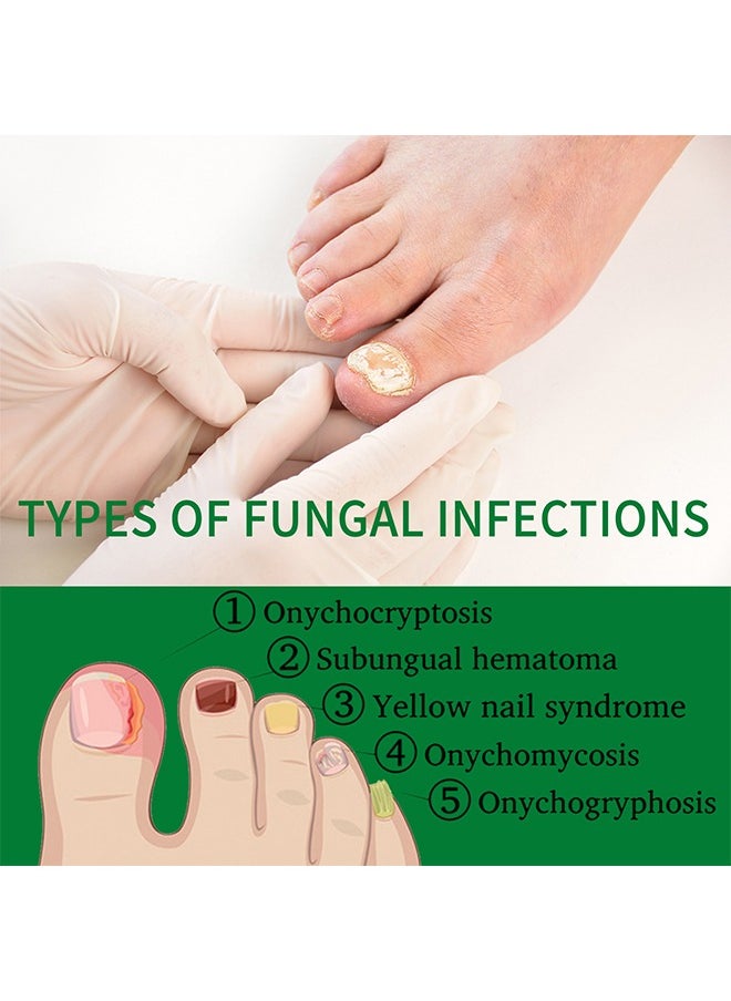 7days Nail Fungus Treatment for Nail Care Onychomycosis Repair and Moisturizing, Nail Nutrient Oil Strengthener Oil Serum Ginger Nail Growth Oil 30ml