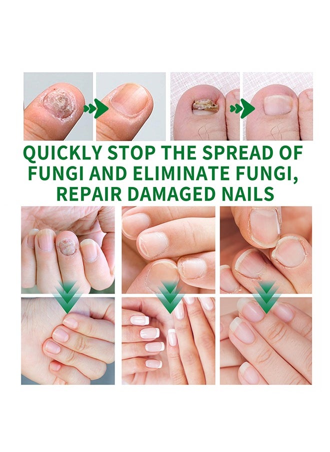 7days Nail Fungus Treatment for Nail Care Onychomycosis Repair and Moisturizing, Nail Nutrient Oil Strengthener Oil Serum Ginger Nail Growth Oil 30ml