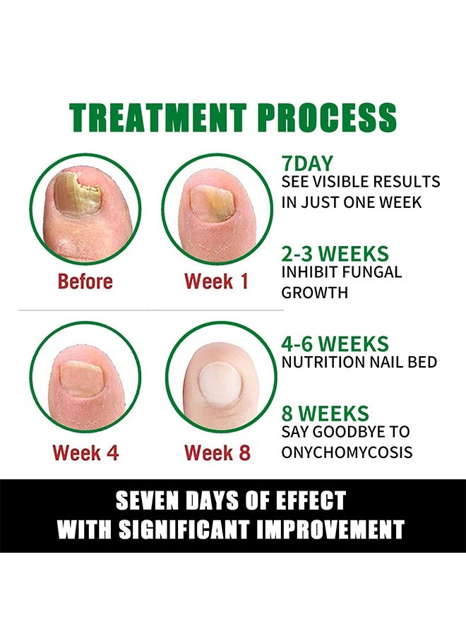 7days Nail Fungus Treatment for Nail Care Onychomycosis Repair and Moisturizing, Nail Nutrient Oil Strengthener Oil Serum Ginger Nail Growth Oil 30ml