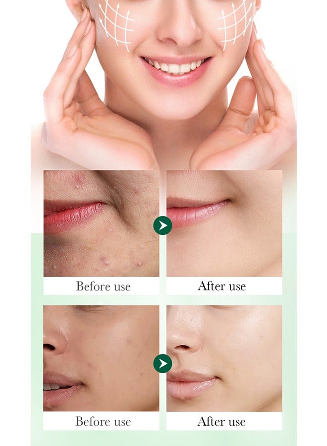 SADOER Salicylic Acid Anti Acne Serum，Contains Salicylic Acid, Niacinamide, Centella Asiatica Extract, And Ceramide To Clear Acne, Fade Acne Marks, Acne Treatment And Repair Damaged Skin (40ml) - Image 5