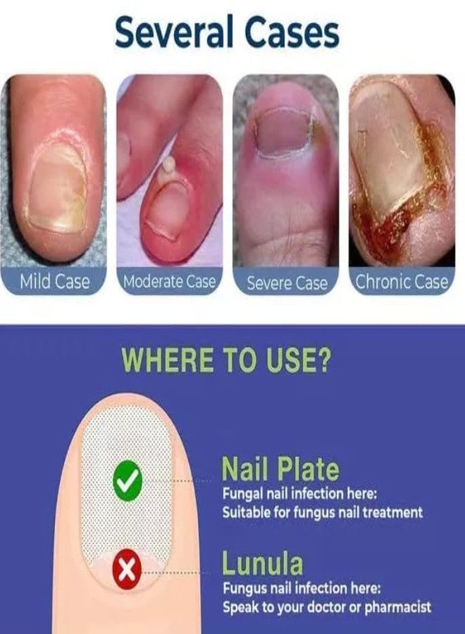 SYLVERA Anti Paronychia Relief Oil 10ml | Herbal Nail Care Oil for Cuticle & Nail Fold Discomfort | Reduces Pain, Redness & Promotes Healthy Nails (2) - Image 3