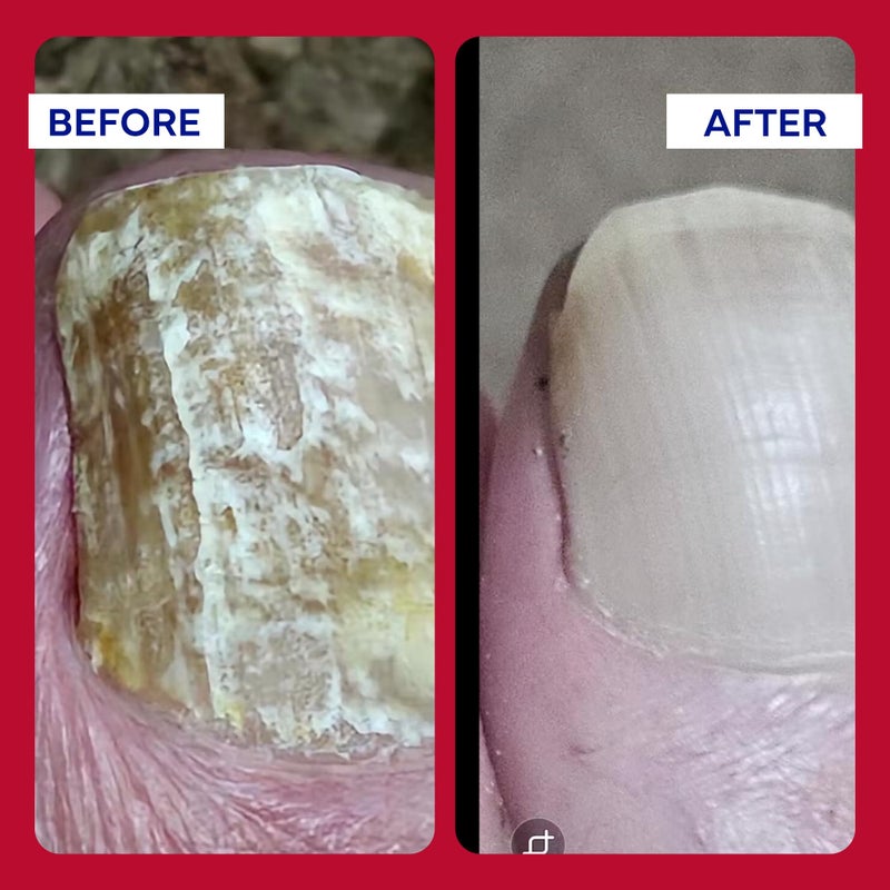 EMUAIDMAX Homeopathic Psoriasis Scalp Treatment Serum â€“ Natural First Aid Concentrate for Dry, Itchy Scalp Relief and Skin Irritations from Psoriasis, Eczema, and Dermatitis, 1oz - Image 3