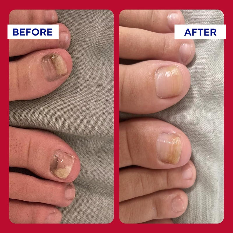 EMUAIDMAX Homeopathic Psoriasis Scalp Treatment Serum â€“ Natural First Aid Concentrate for Dry, Itchy Scalp Relief and Skin Irritations from Psoriasis, Eczema, and Dermatitis, 1oz - Image 4