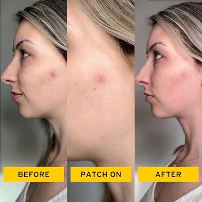 NO B. S. NO BAD STUFF No Bad Stuff - Healing Acne Patches with Hydrocolloid, Waterproof, Invisible Pimple Patches, Wear Under Makeup & Sunscreen, Acne Skin Care for Women & Men, Spot Patches for Pimples, 72 CT - Image 3