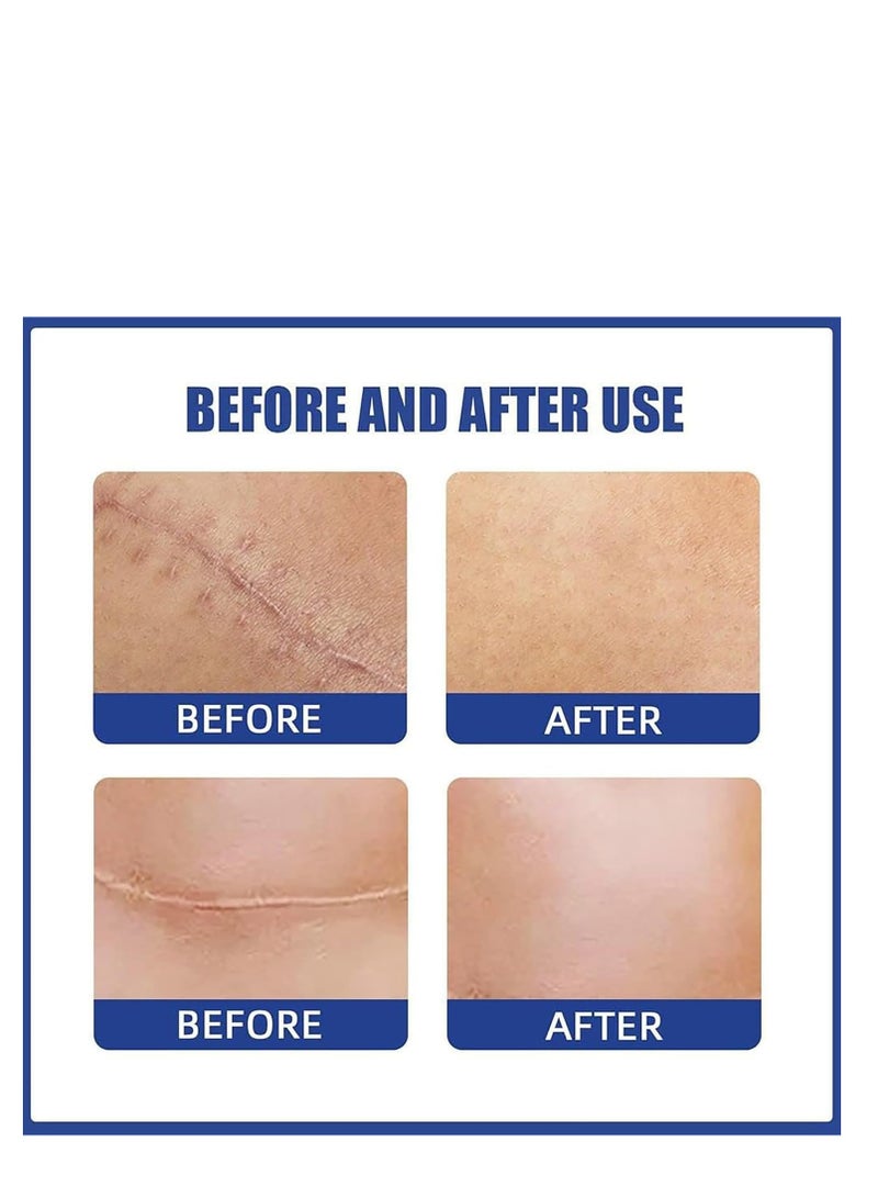 EELHOE Silicone Scar Sheets, Reusable Washable Silicone Scar Tape, Surgery Scars Removal Treatment, Medical Grade Silicone Scar Sheets for Breast 4Pairs - Image 3