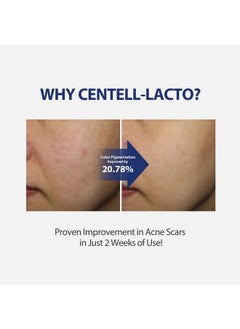 SUNGBOON EDITOR SUNGBOON EDITOR Centell Lacto AC Less Skin Barrier Essence Serum | Acne Treatment for Face | Probiotics Skin Care for Sensitive Skin | Niacinamide Hydrating Face Serum | Korean Skin Care  - Image 5